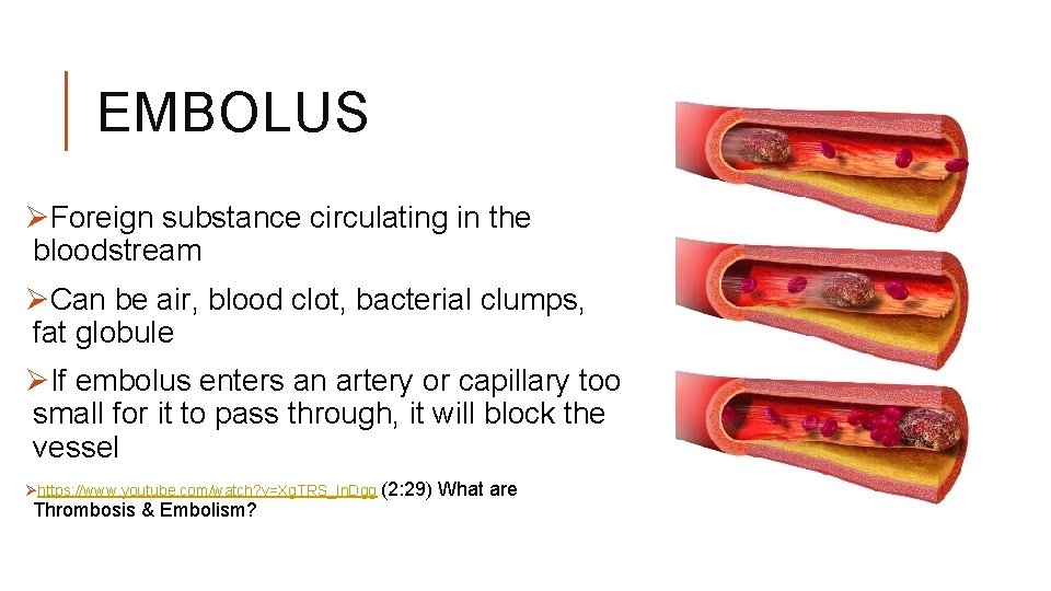EMBOLUS ØForeign substance circulating in the bloodstream ØCan be air, blood clot, bacterial clumps,