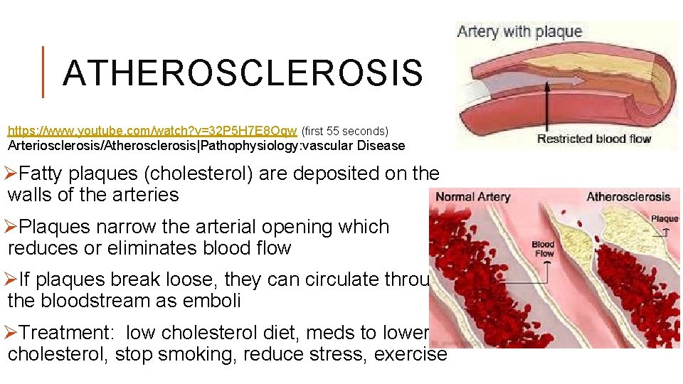 ATHEROSCLEROSIS https: //www. youtube. com/watch? v=32 P 5 H 7 E 8 Oqw (first