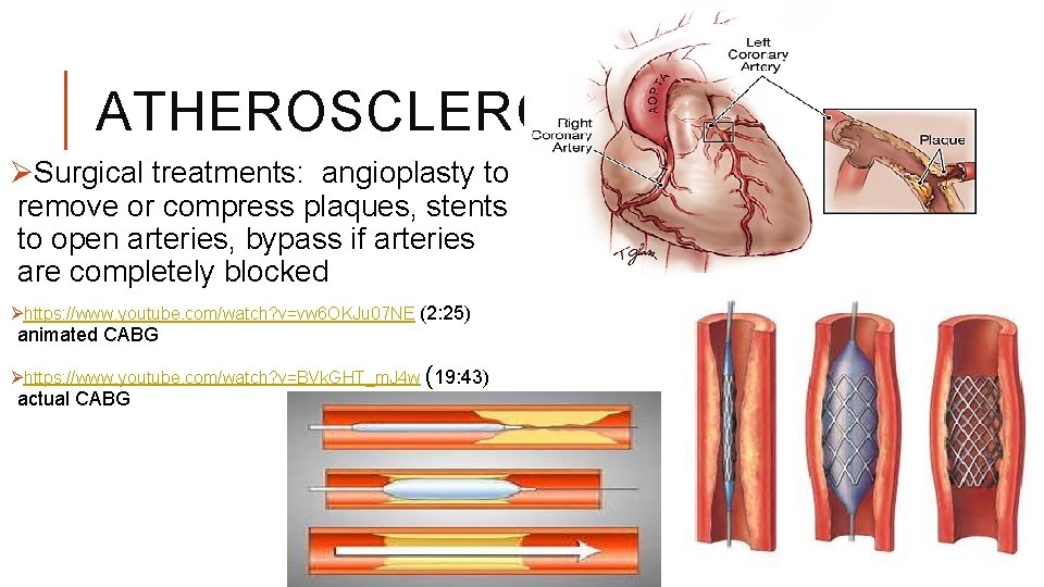 ATHEROSCLEROSIS ØSurgical treatments: angioplasty to remove or compress plaques, stents to open arteries, bypass