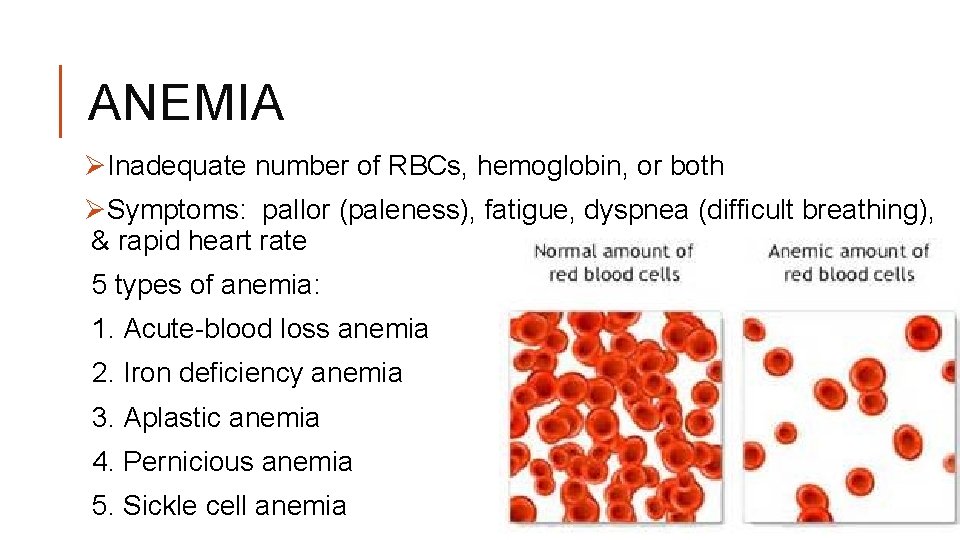 ANEMIA ØInadequate number of RBCs, hemoglobin, or both ØSymptoms: pallor (paleness), fatigue, dyspnea (difficult