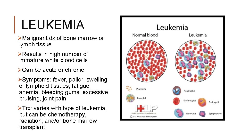 LEUKEMIA ØMalignant dx of bone marrow or lymph tissue ØResults in high number of