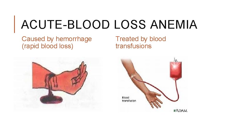 ACUTE-BLOOD LOSS ANEMIA Caused by hemorrhage (rapid blood loss) Treated by blood transfusions 
