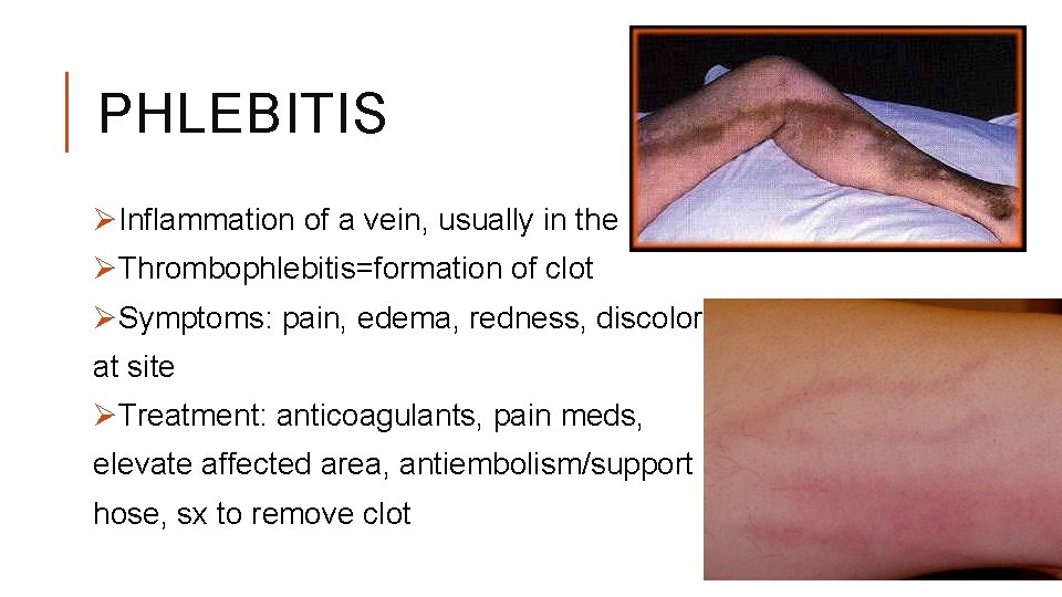 PHLEBITIS ØInflammation of a vein, usually in the leg ØThrombophlebitis=formation of clot ØSymptoms: pain,
