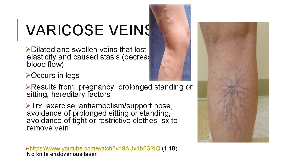 VARICOSE VEINS ØDilated and swollen veins that lost elasticity and caused stasis (decreased blood