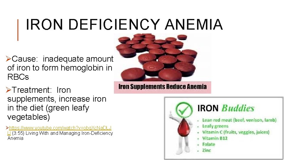 IRON DEFICIENCY ANEMIA ØCause: inadequate amount of iron to form hemoglobin in RBCs ØTreatment: