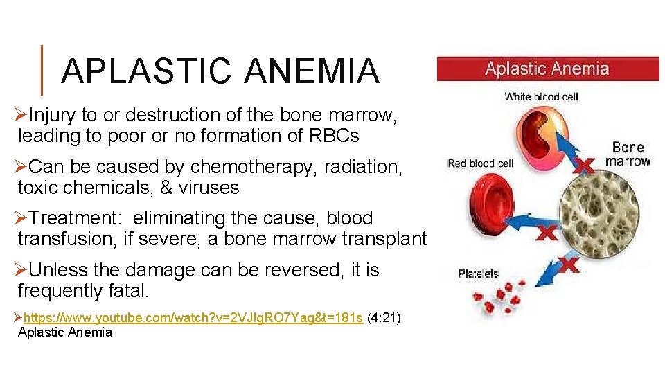 APLASTIC ANEMIA ØInjury to or destruction of the bone marrow, leading to poor or