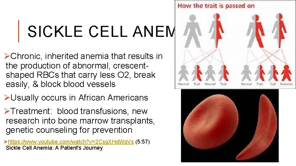 SICKLE CELL ANEMIA ØChronic, inherited anemia that results in the production of abnormal, crescentshaped