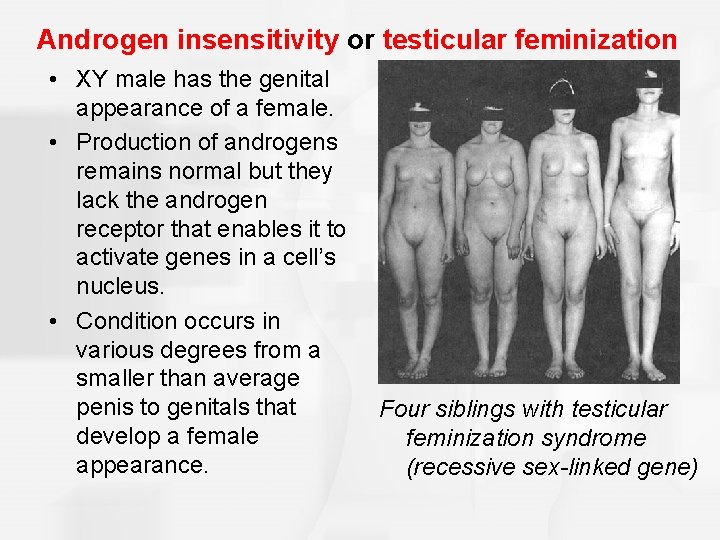 Androgen insensitivity or testicular feminization • XY male has the genital appearance of a
