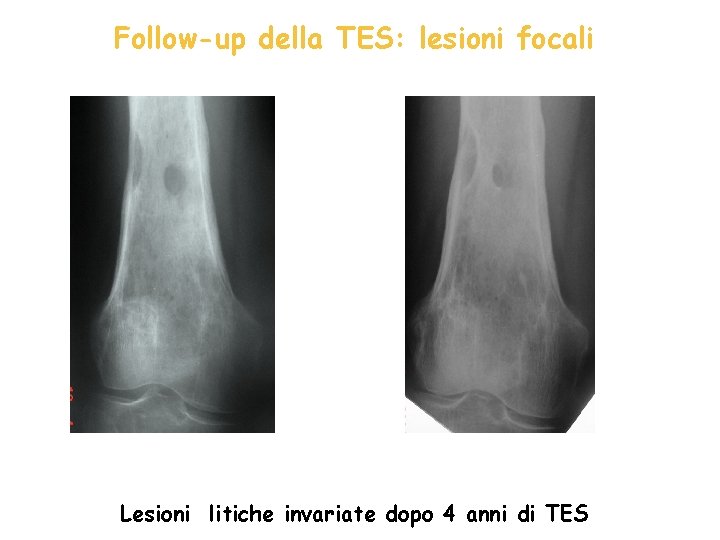 Follow-up della TES: lesioni focali Lesioni litiche invariate dopo 4 anni di TES 