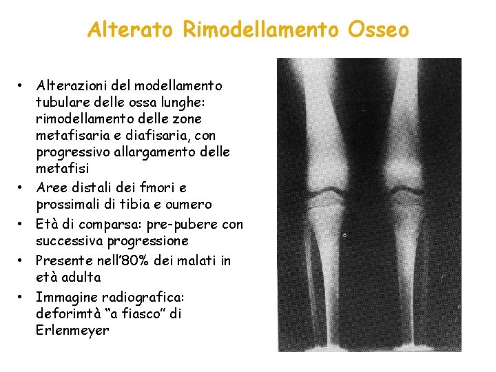 Alterato Rimodellamento Osseo • Alterazioni del modellamento tubulare delle ossa lunghe: rimodellamento delle zone