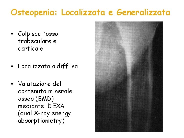 Osteopenia: Localizzata e Generalizzata • Colpisce l’osso trabeculare e corticale • Localizzata o diffusa