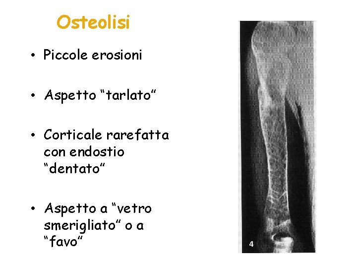 Osteolisi • Piccole erosioni • Aspetto “tarlato” • Corticale rarefatta con endostio “dentato” •