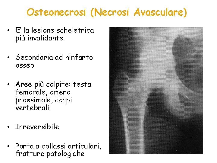 Osteonecrosi (Necrosi Avasculare) • E’ la lesione scheletrica più invalidante • Secondaria ad ninfarto
