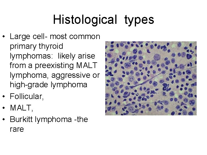 Histological types • Large cell- most common primary thyroid lymphomas: likely arise from a