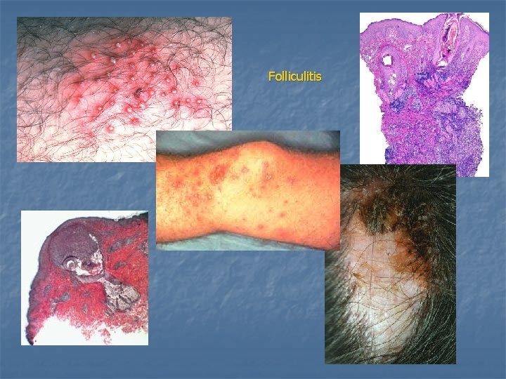 Folliculitis 