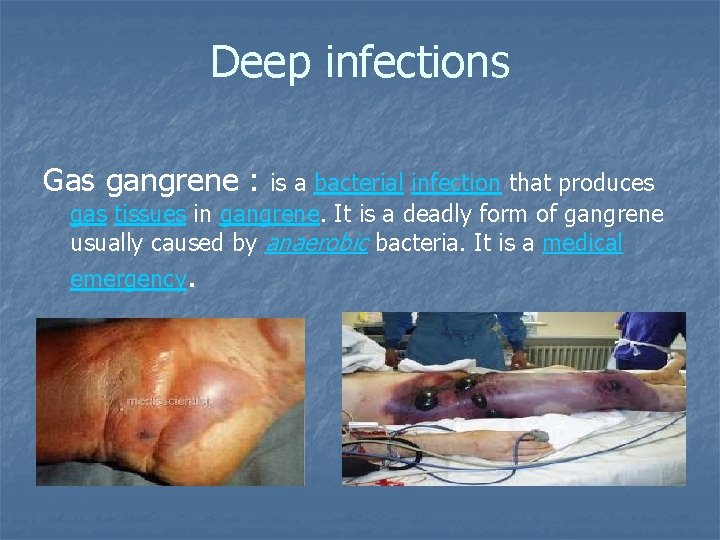 Deep infections Gas gangrene : is a bacterial infection that produces gas tissues in