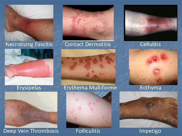 Necrotizing Fascitis Erysipelas Deep Vein Thrombosis Contact Dermatitis Cellulitis Erythema Multiforme Ecthyma Folliculitis Impetigo