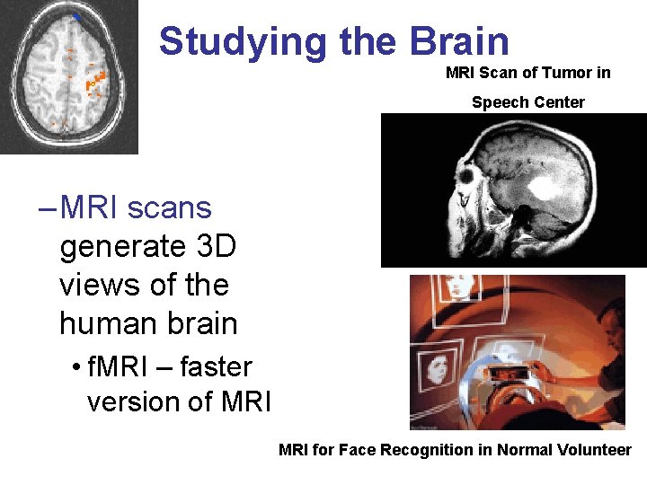 Studying the Brain MRI Scan of Tumor in Speech Center – MRI scans generate