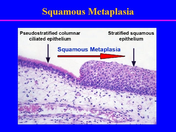 Squamous Metaplasia 