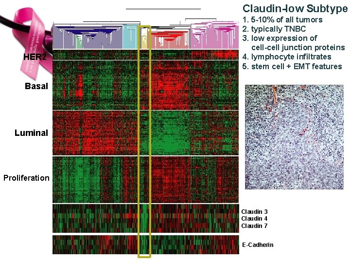 Claudin-low Subtype HER 2 1. 5 -10% of all tumors 2. typically TNBC 3.