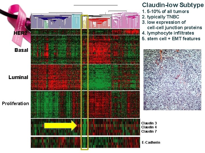 Claudin-low Subtype HER 2 1. 5 -10% of all tumors 2. typically TNBC 3.