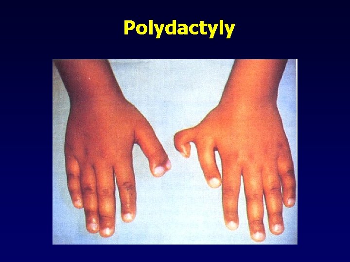 Polydactyly 