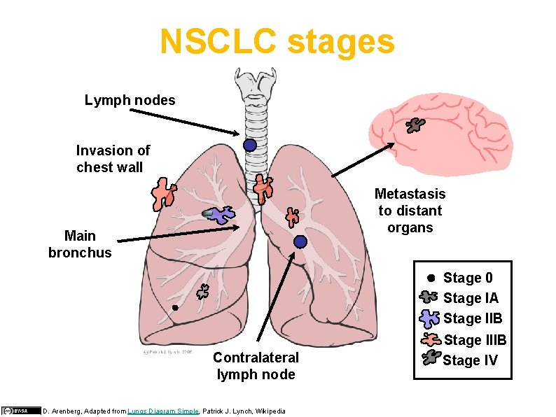 NSCLC stages Lymph nodes Invasion of chest wall Metastasis to distant organs Main bronchus