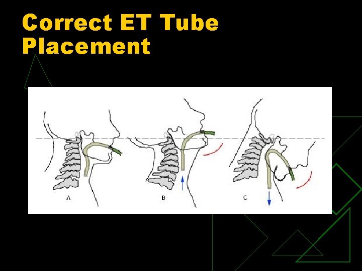 Correct ET Tube Placement 