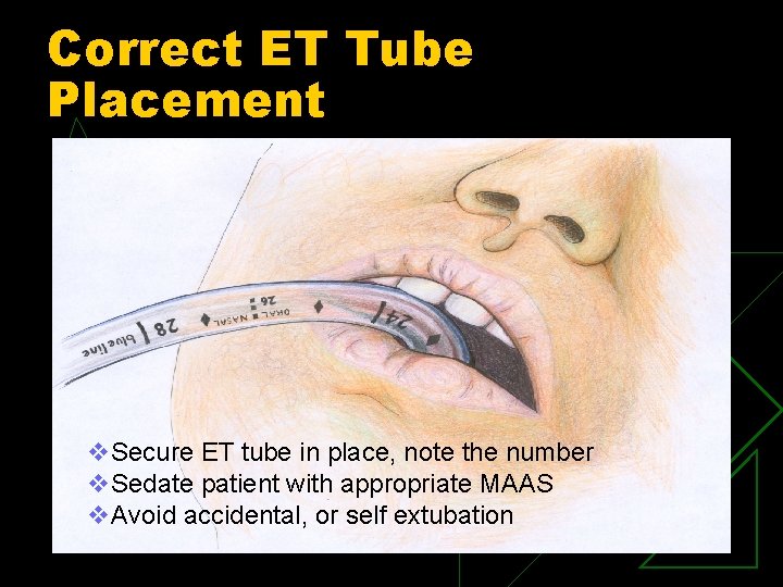 Correct ET Tube Placement v. Secure ET tube in place, note the number v.