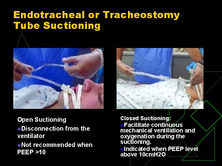 Endotracheal or Tracheostomy Tube Suctioning Open Suctioning v. Disconnection from the ventilator v. Not