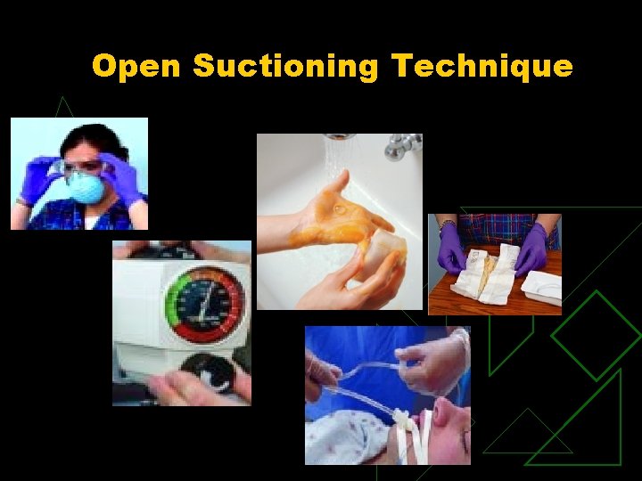 Open Suctioning Technique 