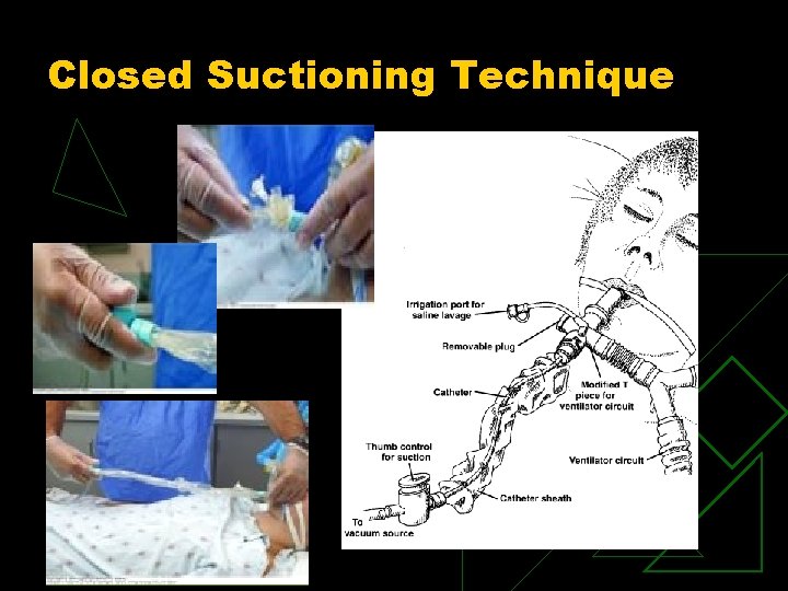 Closed Suctioning Technique 