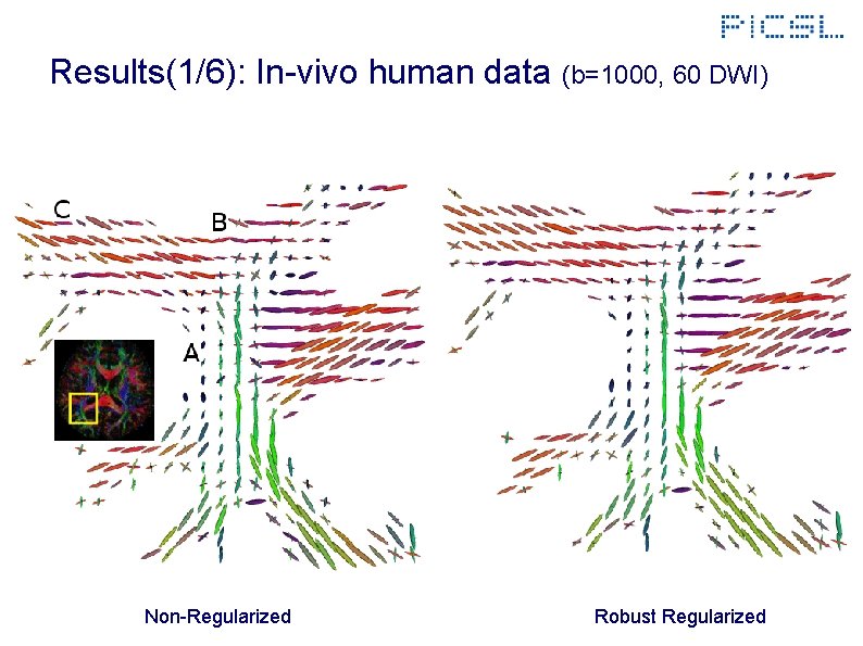 Results(1/6): In-vivo human data (b=1000, 60 DWI) Non-Regularized Robust Regularized 