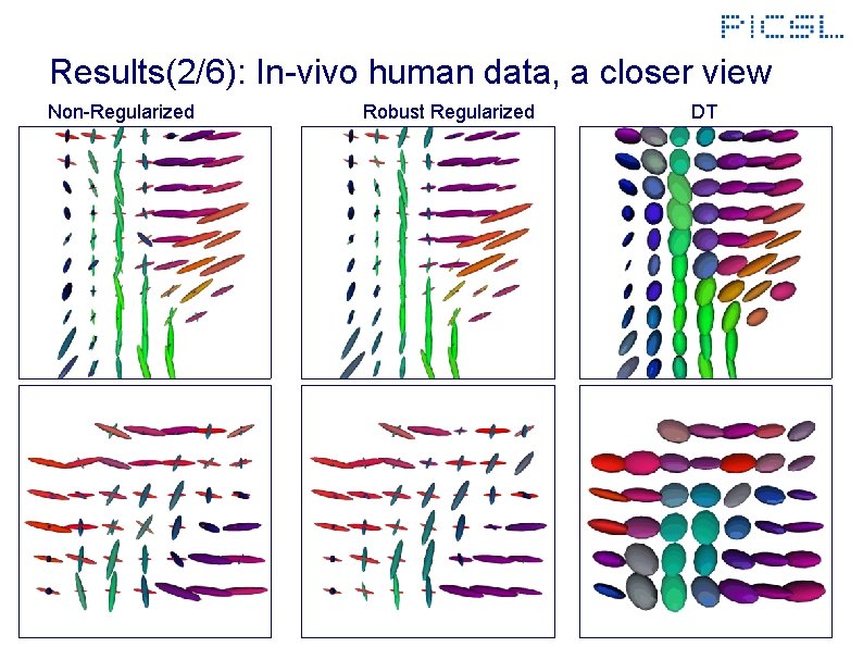 Results(2/6): In-vivo human data, a closer view Non-Regularized Robust Regularized DT 