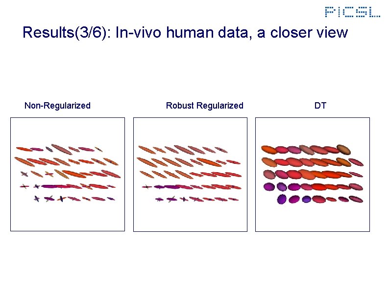 Results(3/6): In-vivo human data, a closer view Non-Regularized Robust Regularized DT 