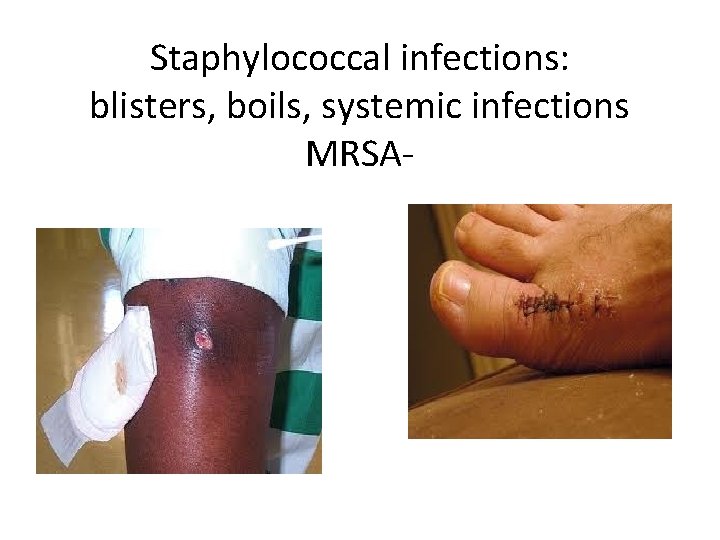 Staphylococcal infections: blisters, boils, systemic infections MRSA- 