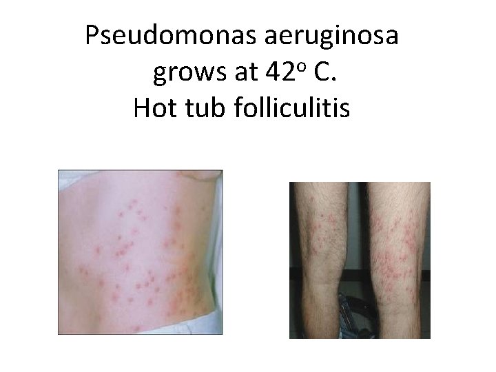 Pseudomonas aeruginosa o grows at 42 C. Hot tub folliculitis 