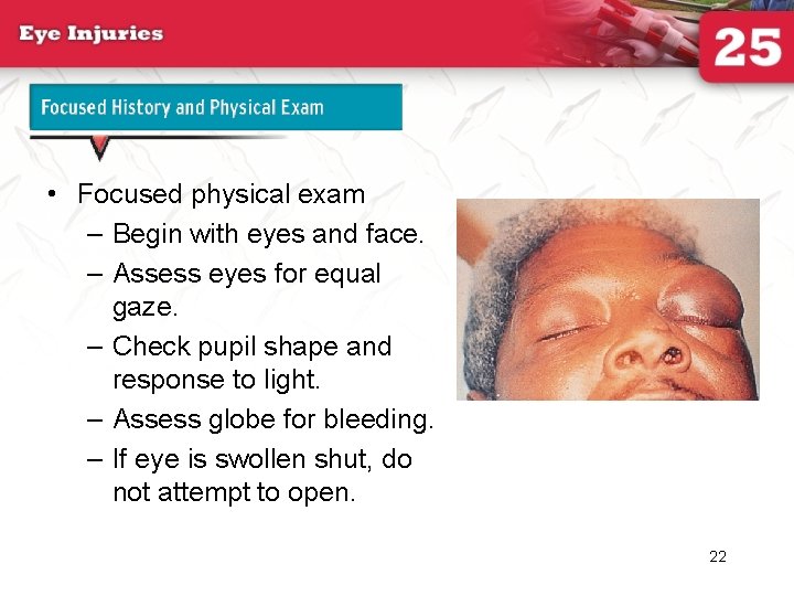 Focused History and Physical Exam continued • Focused physical exam – Begin with eyes