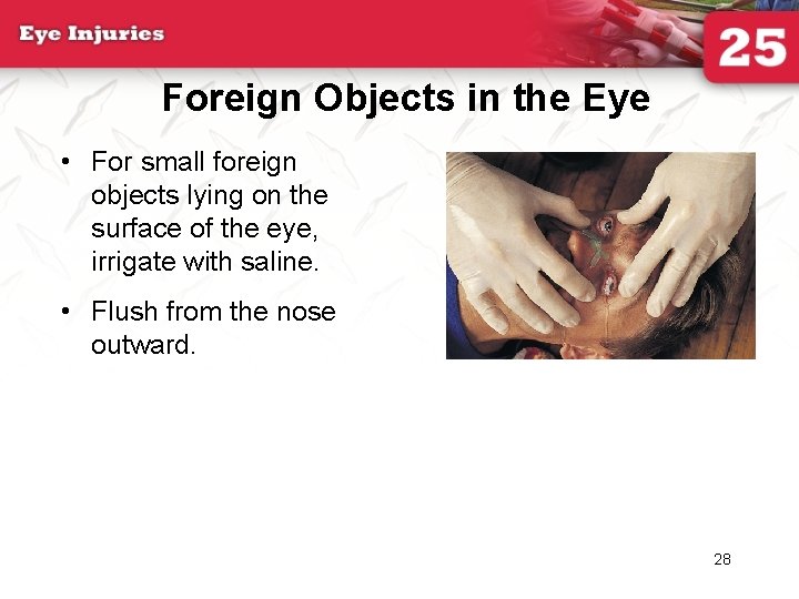 Foreign Objects in the Eye • For small foreign objects lying on the surface