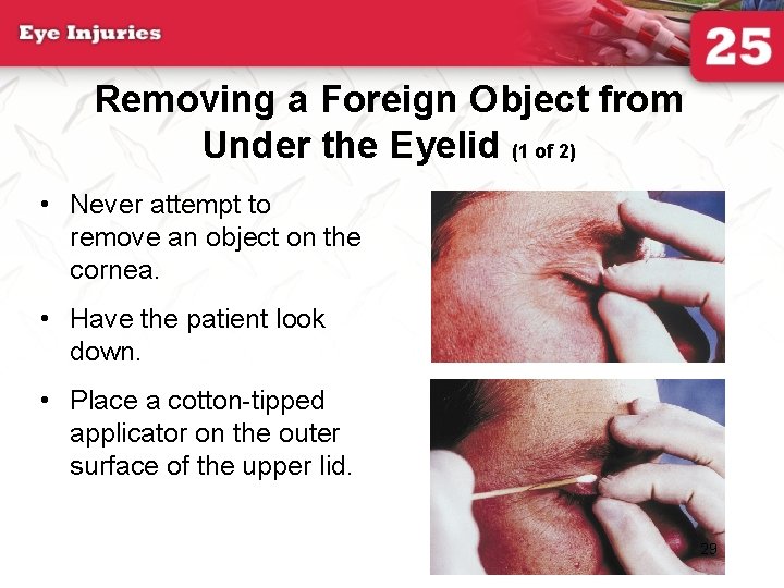 Removing a Foreign Object from Under the Eyelid (1 of 2) • Never attempt