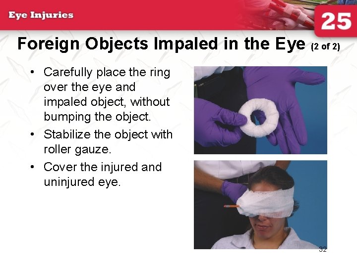 Foreign Objects Impaled in the Eye (2 of 2) • Carefully place the ring