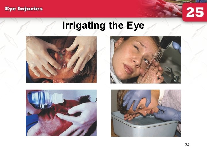 Irrigating the Eye 34 