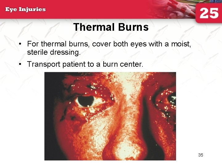 Thermal Burns • For thermal burns, cover both eyes with a moist, sterile dressing.