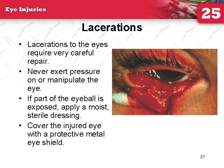 Lacerations • Lacerations to the eyes require very careful repair. • Never exert pressure