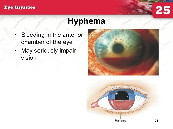 Hyphema • Bleeding in the anterior chamber of the eye • May seriously impair