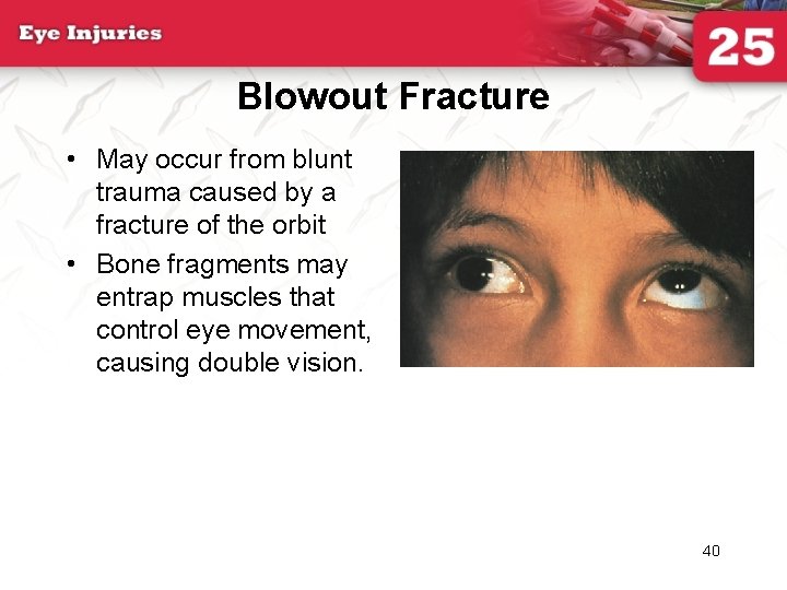 Blowout Fracture • May occur from blunt trauma caused by a fracture of the