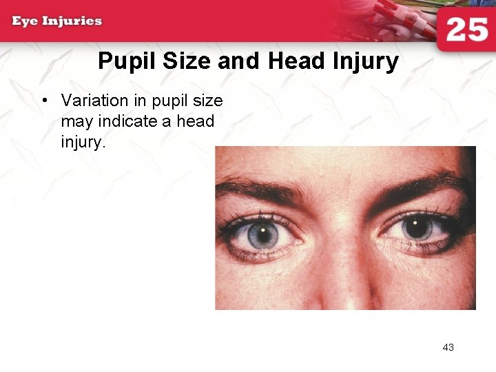 Pupil Size and Head Injury • Variation in pupil size may indicate a head