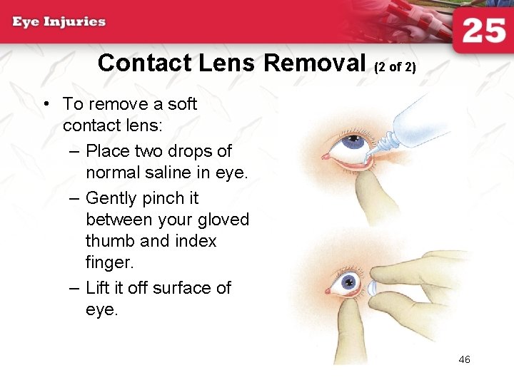 Contact Lens Removal (2 of 2) • To remove a soft contact lens: –