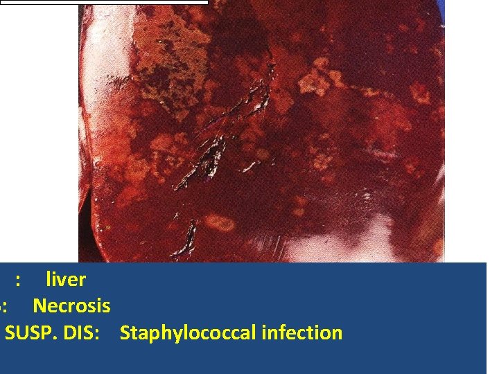 : liver S: Necrosis SUSP. DIS: Staphylococcal infection 