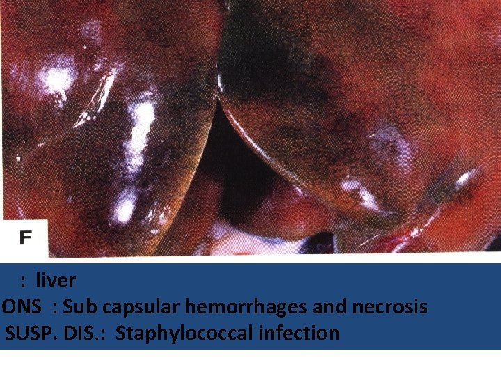 : liver IONS : Sub capsular hemorrhages and necrosis SUSP. DIS. : Staphylococcal infection